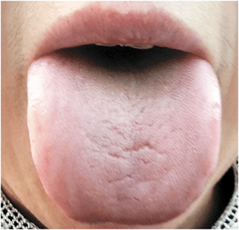 阴虚,阳虚傻傻分不清?张嘴伸舌一看便知