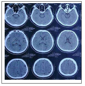 颅脑检查，CT和MRI哪个好？