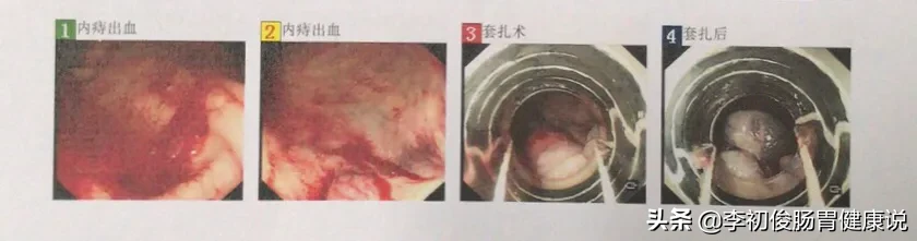 一次肠镜操作,一举三得同时完成肠道检查、套扎止血、消除内痔!