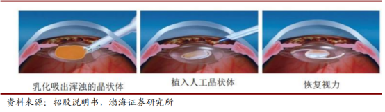 上万的人工晶状体，成本仅百元，这家眼科龙头背后老板拥38亿身家