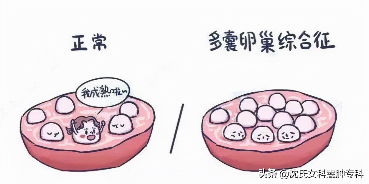 多囊卵巢综合征的治疗方法与调理建议