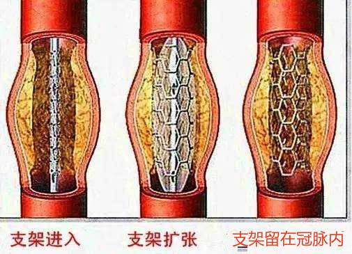 辟谣！进口支架是不是比国产支架更好？专家揭露：从4方面来比较