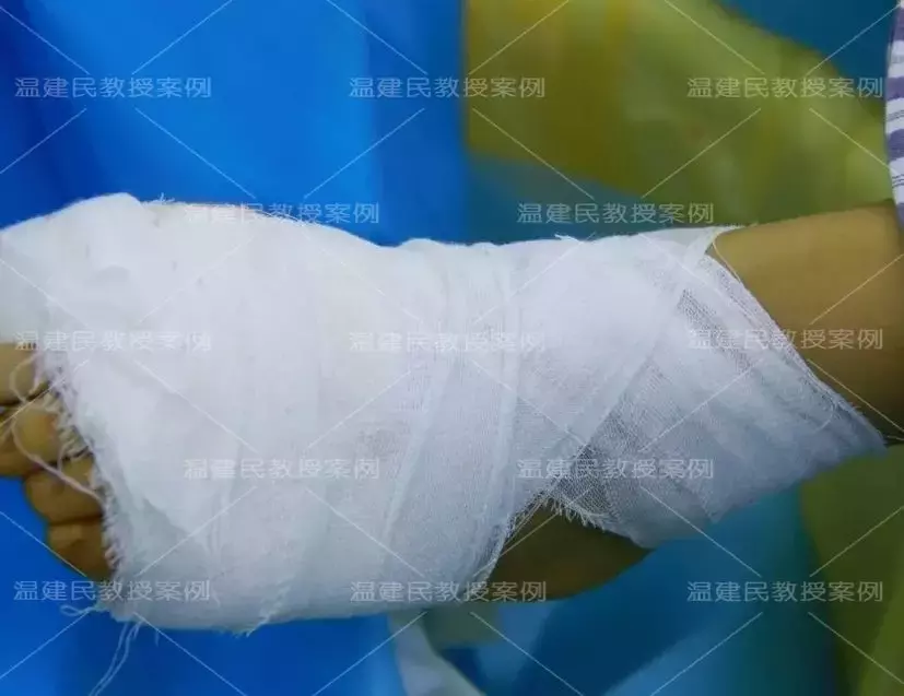 案例:轻度拇外翻不治疗,拖延20年成重度,疼痛难忍才来手术