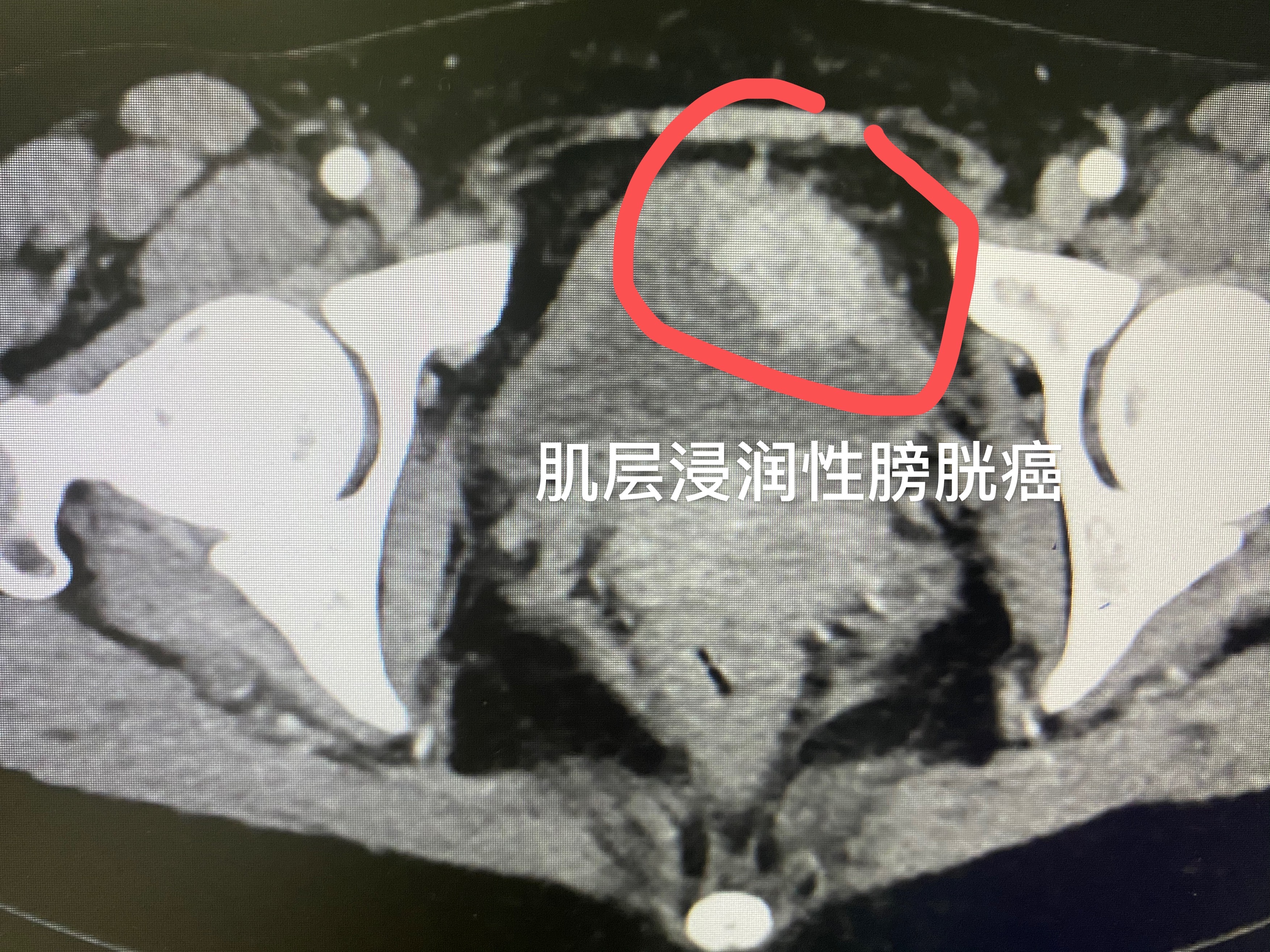 血尿以为是肾病，去了肾内科被推到泌尿外科！如何自我判断？