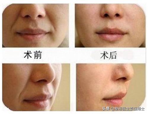 关于如何“消除”法令纹，整形医生有话说