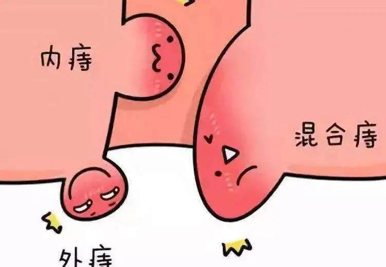 人为什么会得痔疮？