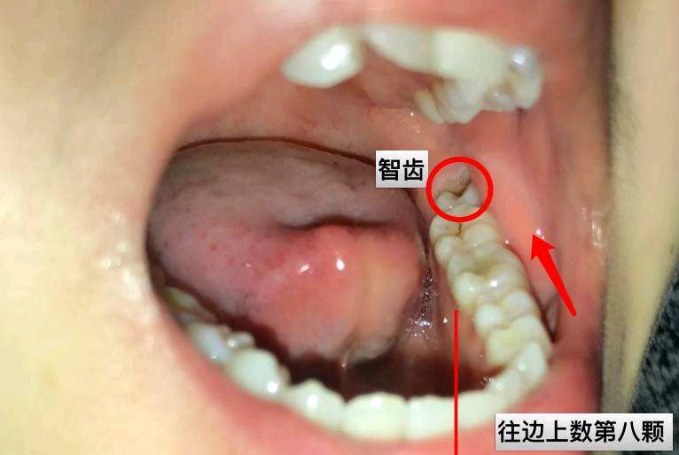 智齿到底有没有必要拔，知道这3点能帮你省不少钱