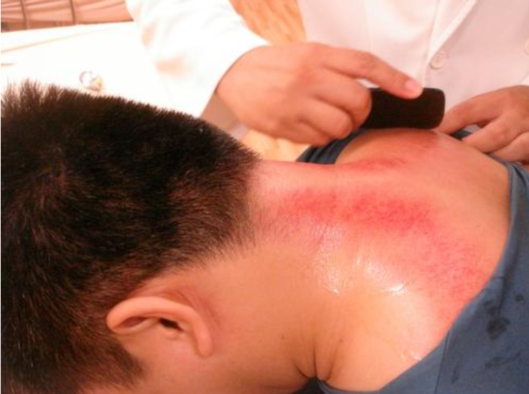 魔法养生小精灵丨无痛刮痧走罐,轻松缓解体内湿气