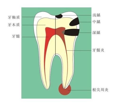 牙疼剧烈难以忍受，你可能是得了牙髓炎，得抓紧去“杀神经”了