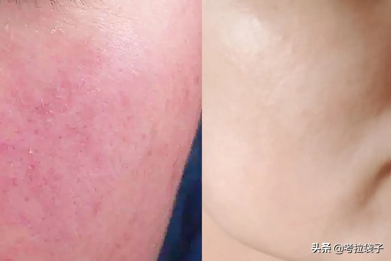 皮肤干燥过敏怎样处理（皮肤干燥过敏用什么护肤品）