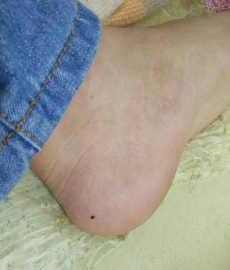 身体出现这样的痣,可能是癌细胞"在试探",快看你有没有