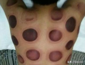 健康科普堂 | 拔罐讲义