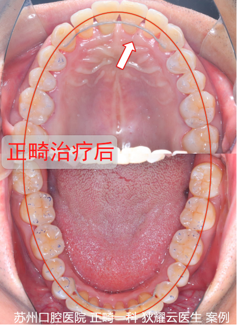 成年人矫正导致牙齿松动？成人矫正，到底难在哪？