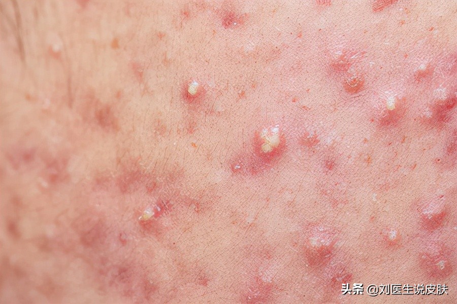 皮肤病涂的含激素软膏，安全吗？你至少要知道这2点