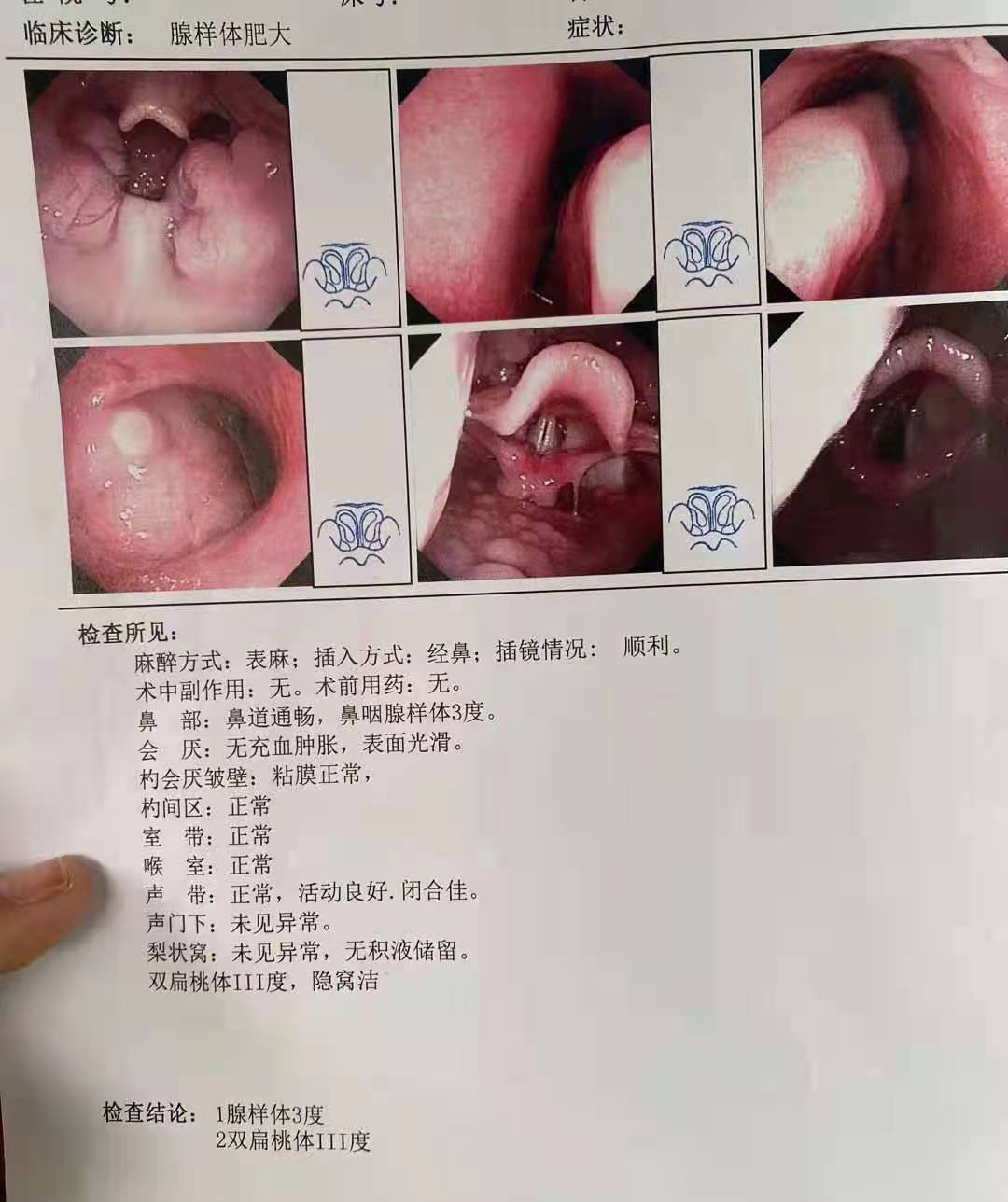 小儿腺样体肥大危害大，中医治疗有优势