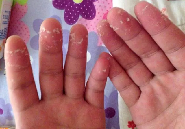 手脱皮的表现在医学上被称为"剥脱性角质松解症",多出现在手的掌心,且