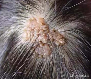 皮脂腺瘤怎么治疗（痣有很多种）