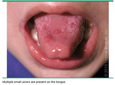 腭舌弓发炎图片(儿科医生谈儿童夏季常见疾病) - 赤虎壹号