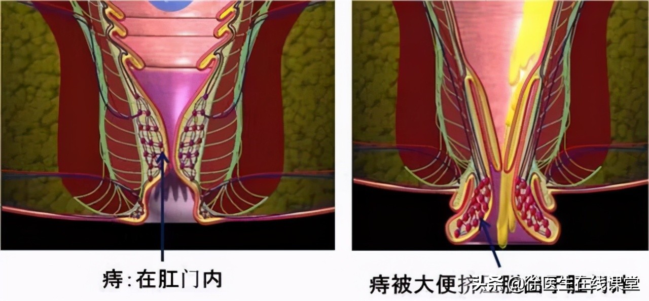 肛门边的肉球,除了痔疮,还可能是什么,需要治疗吗?