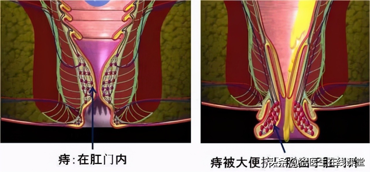 肛門邊的肉球,除了痔瘡,還可能是什麼,需要治療嗎?