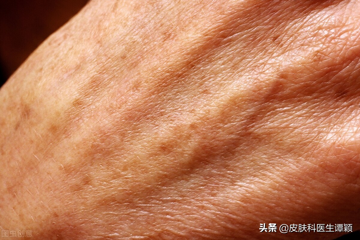 皮肤科医生和你聊聊：老年斑/脂溢性角化可以如何治疗？