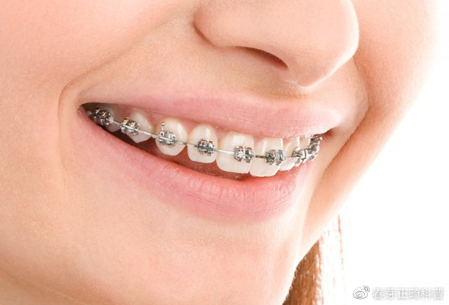牙套汇总大全,6哪种牙套更适合你?