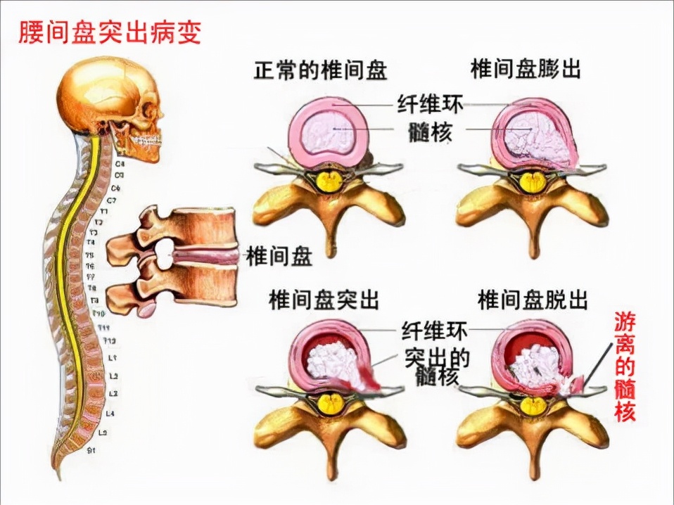 腰椎间盘突出患者怎么康复锻炼，可以缓解甚至根治疼痛