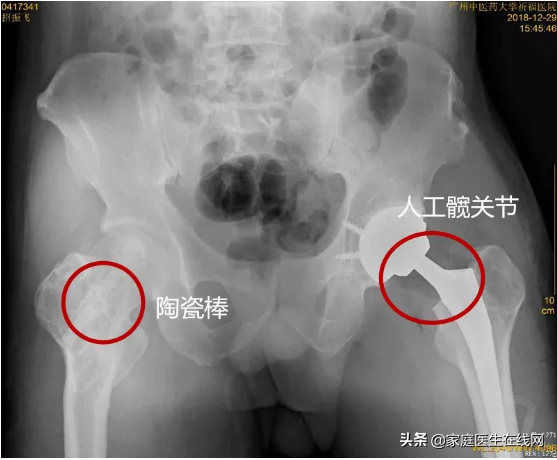 股骨头坏死=“不死的癌症”？1cm切口的微创手术了解一下