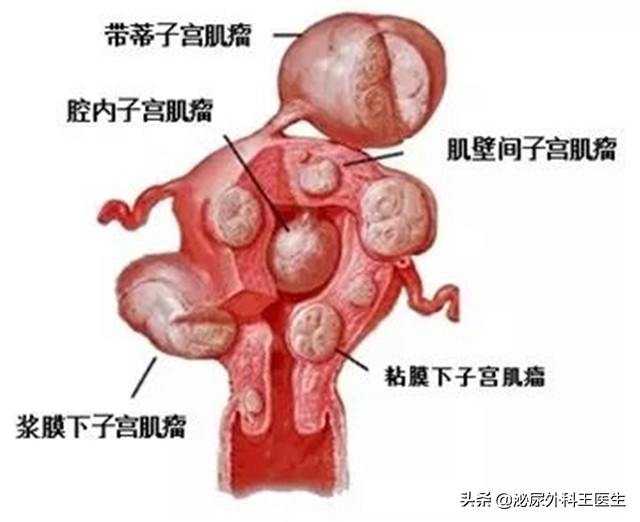 女人切除子宫,对性生活有什么影响呢?