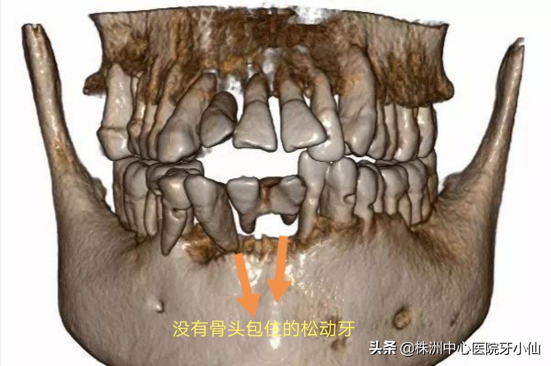 看个牙还需要拍CT？是真的有用，还是多此一举？#清风计划#