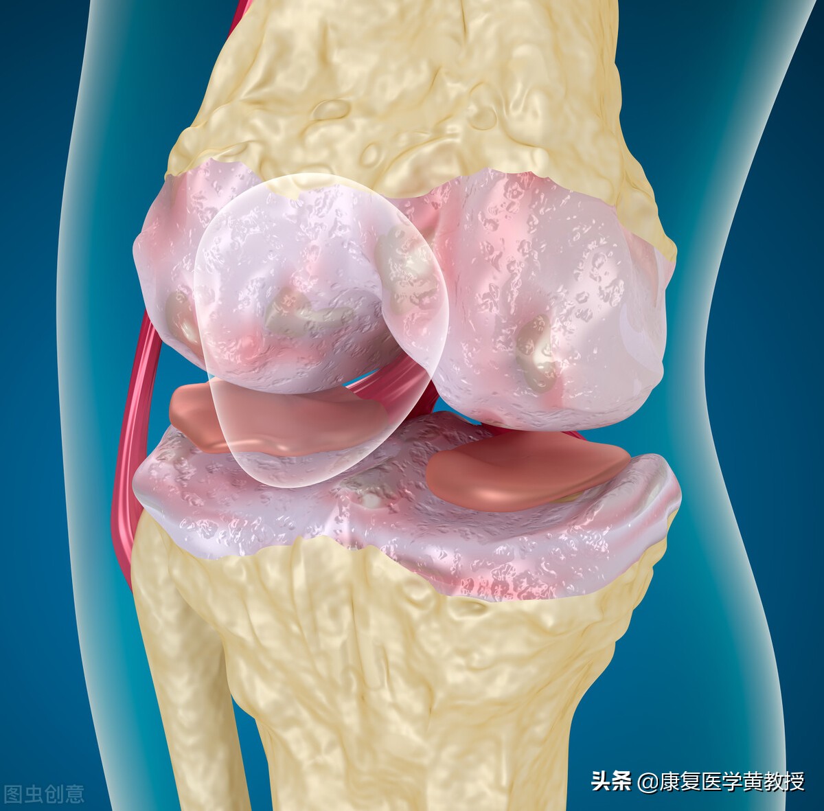 骨刺是一种病吗？按摩贴膏药可以消除骨刺吗？