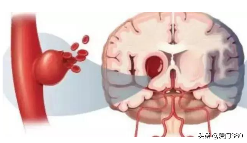 脑淤血和生活习惯有关？真没瞎说，预防才是关键