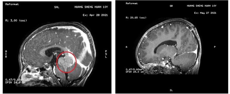 10岁小孩头晕呕吐“感冒”一个月，竟是颅内肿瘤