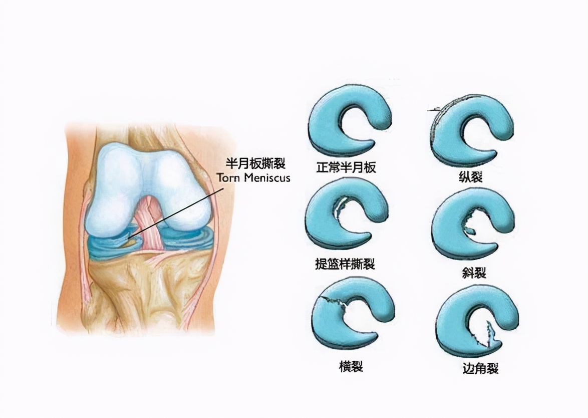 膝盖内侧的疼痛怎么选穴？医生：虽然病因很多，但是都可选曲泉