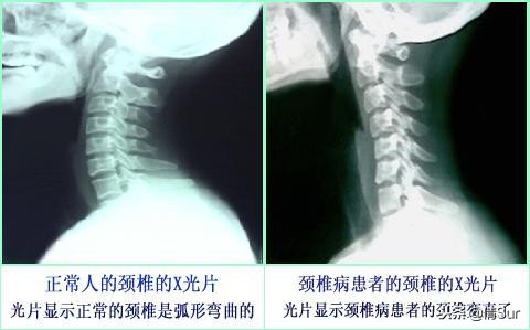 颈椎病—21世纪最大的冤案