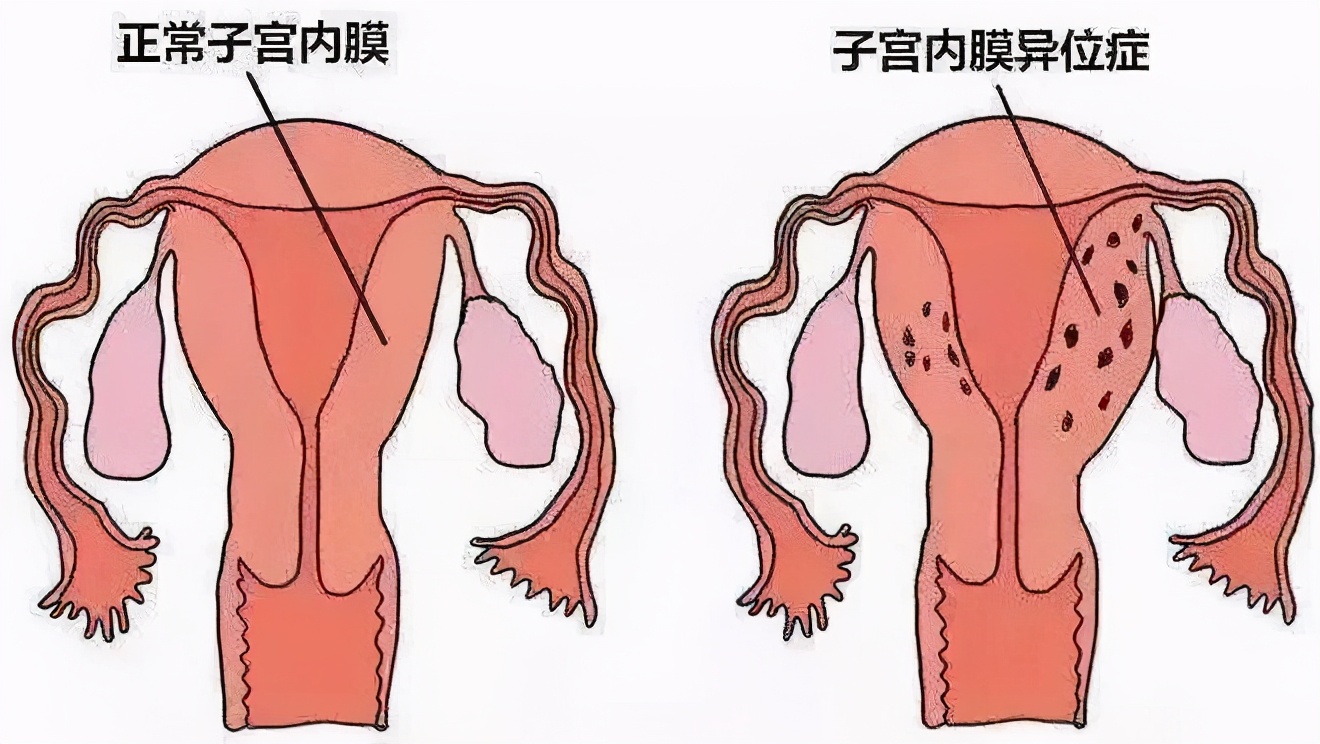 子宫内膜异位症治疗：如何让出走的子宫内膜归位