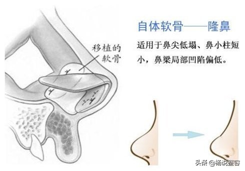 科普：隆鼻失败后怎么修复呢？