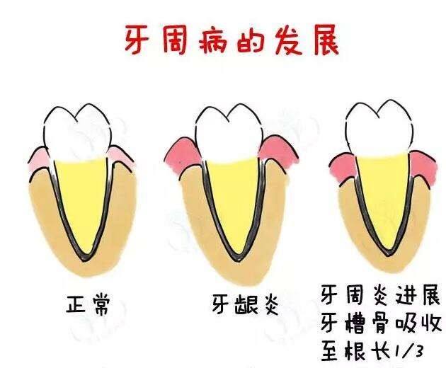 来自牙医的真诚的建议：不要随便做烤瓷牙，这些弊端要提前了解