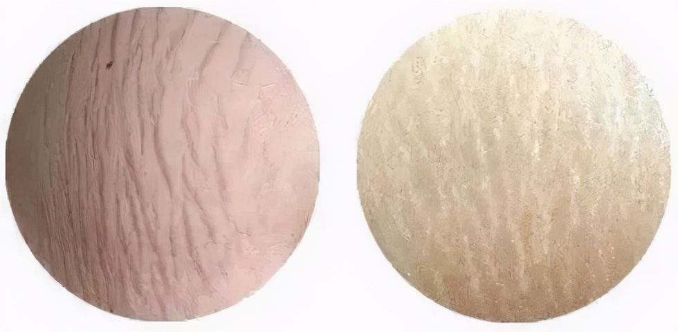 我明明不胖,为什么也长「肥胖纹」?一文解救裂开的皮肤