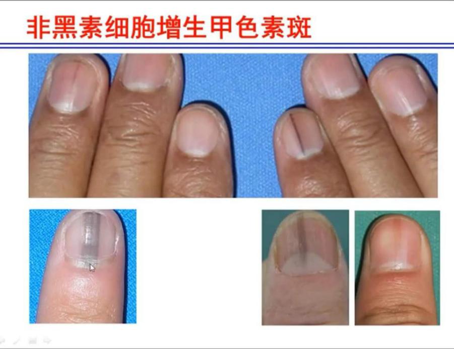 指甲上有条黑线是什么病？甲黑色素瘤or甲母痣？良性还是恶性？