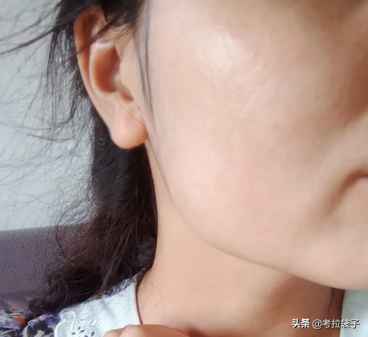 皮肤干燥过敏怎样处理（皮肤干燥过敏用什么护肤品）