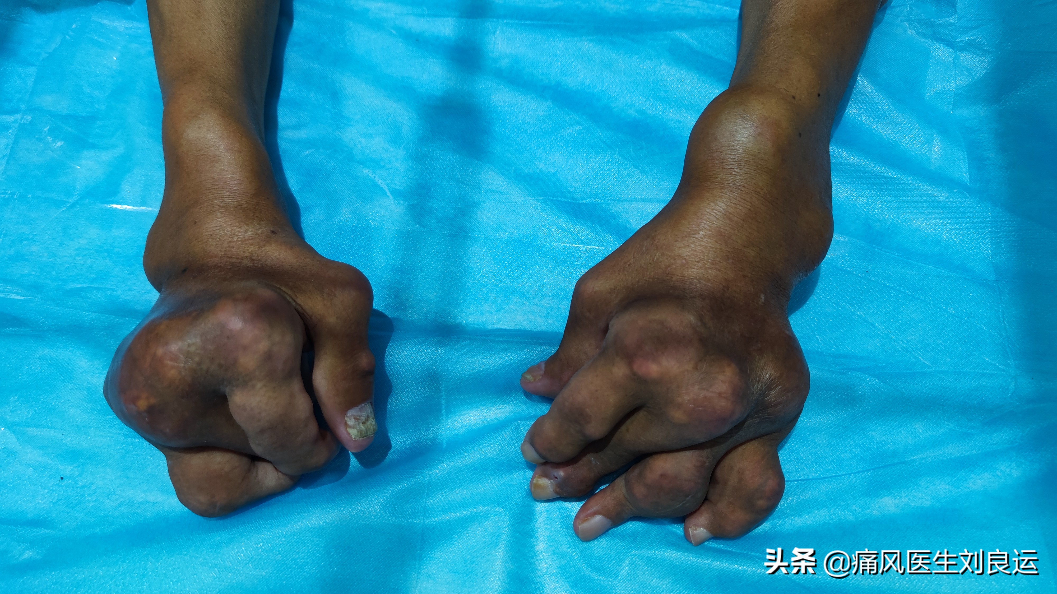 痛风石手术多少钱四肢关节长满痛风石的他一年后来医院