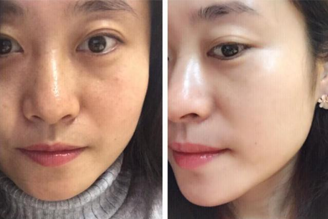 打美白针有效果么 打美白针的副作用有哪些 - 汽车时代网