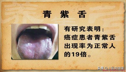 中医：有这1种舌象的人，当心癌症找上门！建议尽快做检查