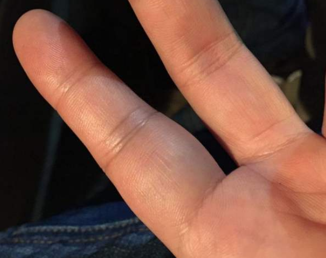 手指有腱鞘炎，怎么治才能好得快？别花冤枉钱了，医生教您5招