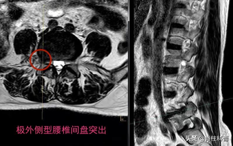 X光看不清，CT辐射大，腰突只想做最贵的核磁共振，为什么不行？