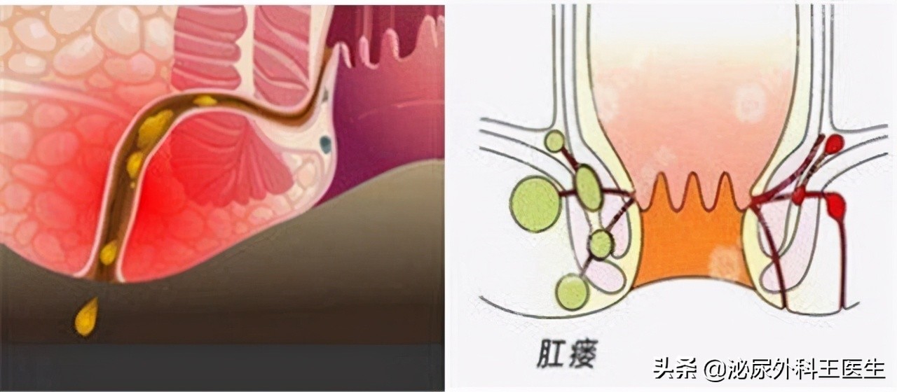 肛瘘手术到底有多痛?