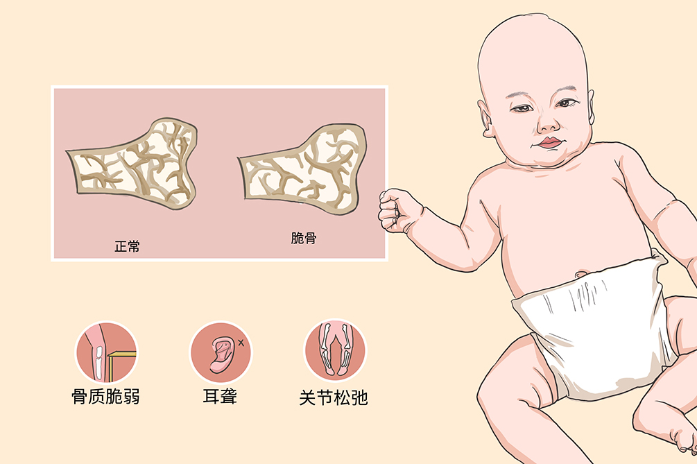 "瓷娃娃病"——小儿成骨不全的分型及治疗原则