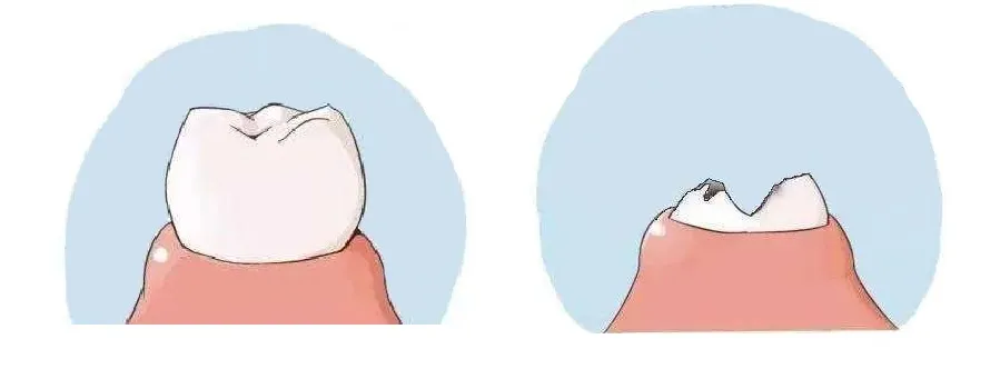 牙齿烂了只剩下半截,是不管?还是拔掉?