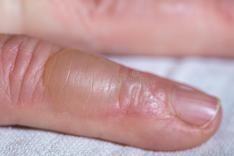烧烫伤后如何及时处理，出现疤痕怎么办？